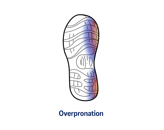 Over Pronation